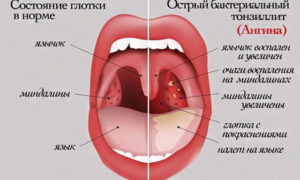 Постоянный сухой кашель и красное горло с оттеком