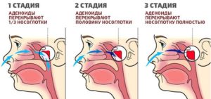 Аденоиды 3 степени гомеопатия