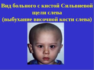Умеренно расширены сильвиевы щели