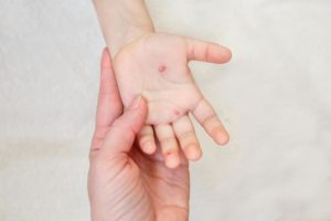 Прыщики на ладонях при ветрянке