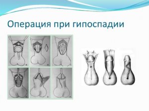 Гипоспадия