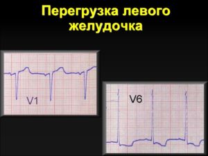 Повышение электрической активности