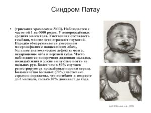 Трисомия по 22 хромосоме у эмбриона