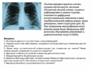 Легочный рисунок усилен корни расширены