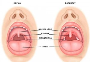 Постоянный сухой кашель и красное горло с оттеком