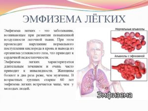 Сколько живут с эмфиземой легких