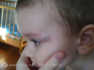 У ребенка после удара над ухом на кости шишка и покраснение