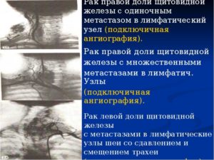 Фокальные изменения в правой доле щитовидной железы