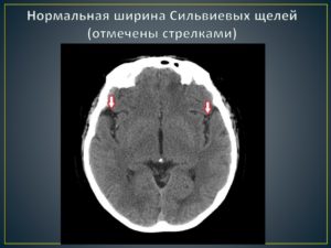 Умеренно расширены сильвиевы щели
