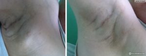 Добавочная доля молочной железы