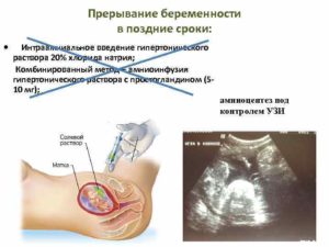 Прерывание беременности на позднем сроке