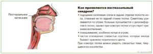 Ком в горле, слизь из носа стекает по горлу