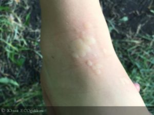 Волдыри как от крапивы