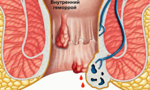 Болезненное уплотнение слева от заднего прохода