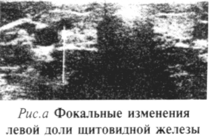 Фокальные изменения в правой доле щитовидной железы