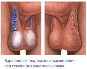 Посинение мошонки
