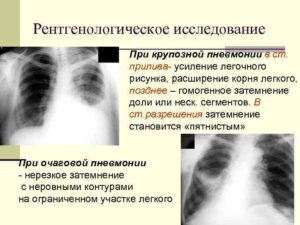 Легочный рисунок усилен корни расширены