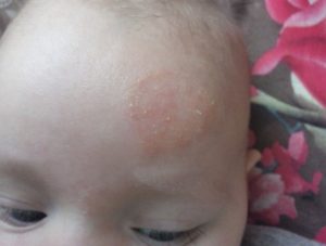 Красные шершавые пятна, мелкие точки на лице у ребенка, помогите