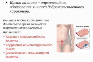 Левый яичник прощупывается сильнее чем правый