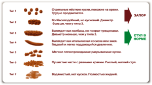 Диарея после желчегонных препаратов