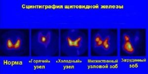 Фокальные изменения в правой доле щитовидной железы