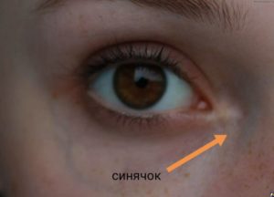 Вздулись вены после пореза, желтые круги под глазами