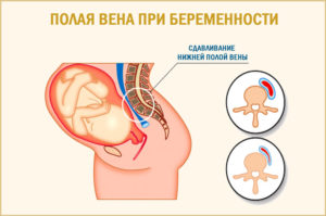 Венозный поток во время беременности