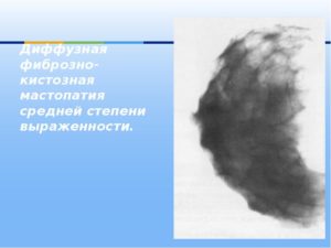 Двусторонняя фиброзная мастопатия. Кл. гр.1б