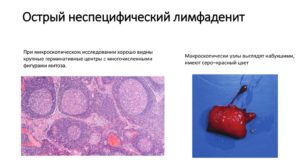 Неспецифический лимфаденит