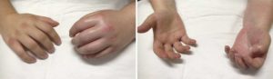 Не проходит боль и отёк после перелома пальца руки