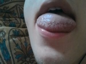 Сбоку на языке справа белый прыщик