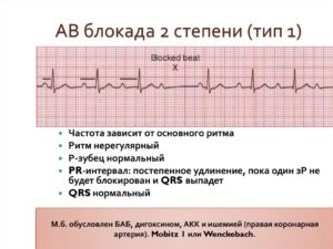 АВ блокада 2 степени