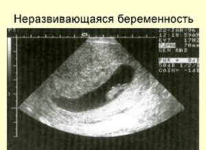 Планирование после двух неразвивающихся беременностей