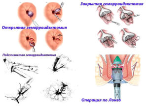 Удалила анальную бахромку