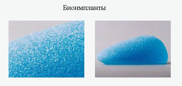 Биоимпланты на основе карбоксиметилцеллюлозы