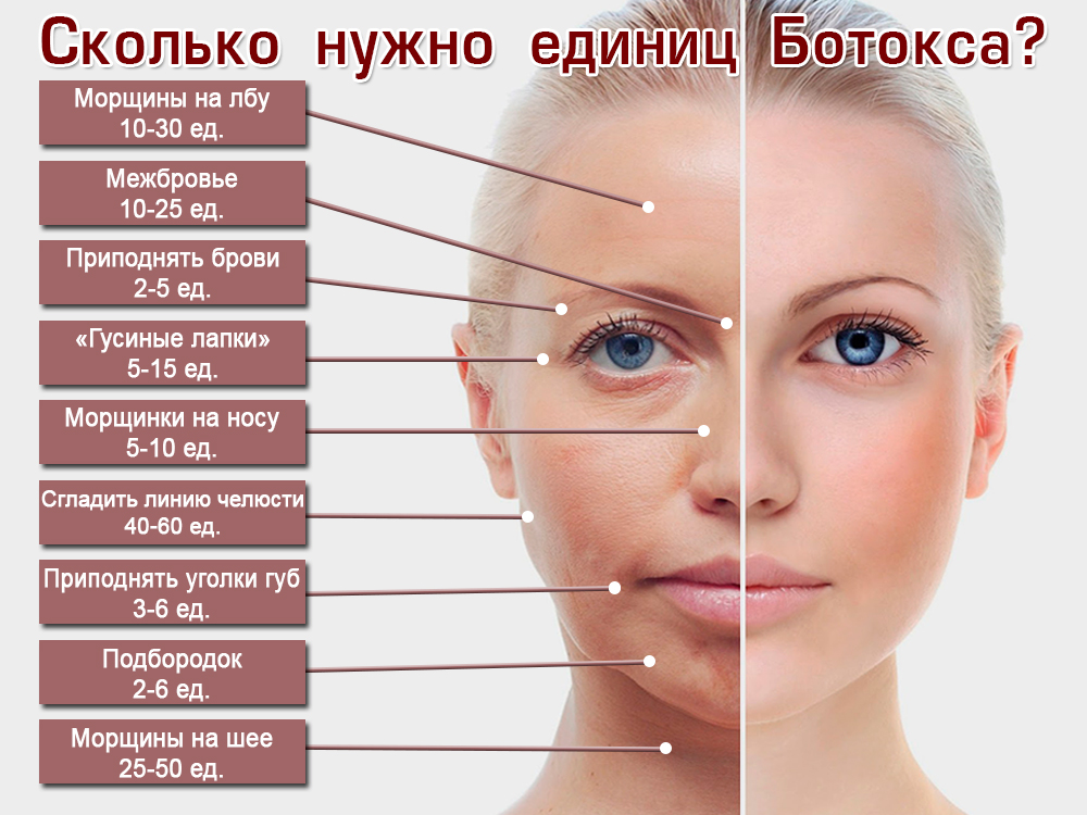 Сколько единиц ботокса нужно гусиные лапки