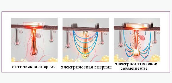 Совмещение оптической и электрической энергии при элос эпиляции