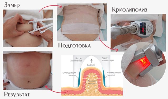 Этапы проведения процедуры криолиполиза