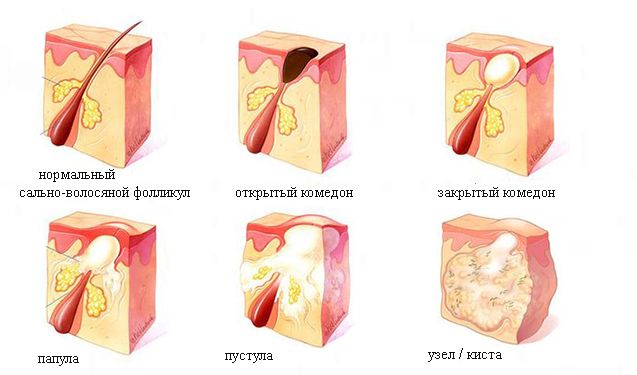 Основные формы акне на лице