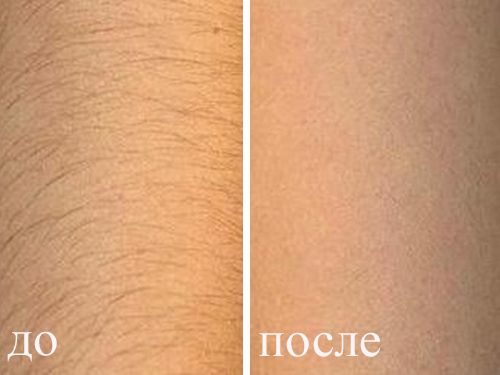 Фотоэпиляция фото до процедуры и после