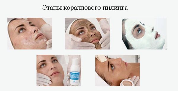 Этапы процедуры кораллового пилинга