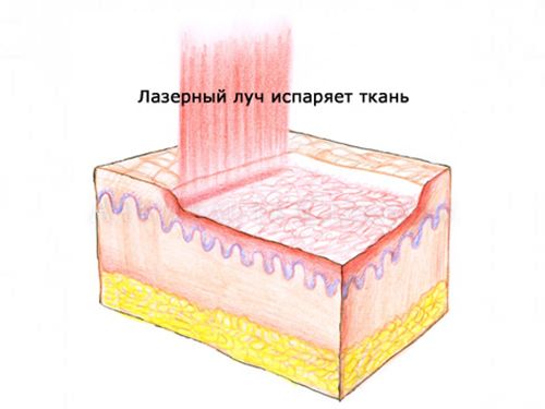 Лазерное удаление рубцов и шрамов на лице и теле