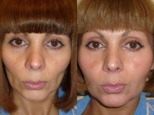 Липофилинг щек фото до и после процедуры