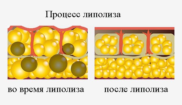 Расщепление жировых клеток или процесс липолиза