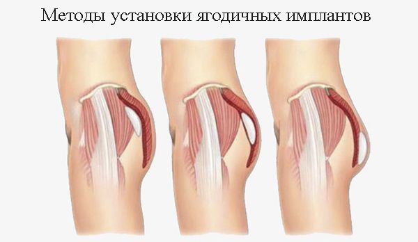 Методы установки ягодичных имплантов