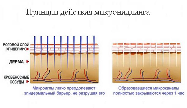 Принцип действия микронидлинга или мезороллотерапии