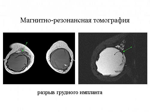 Результат магнитно-резонансной томографии молочных желез