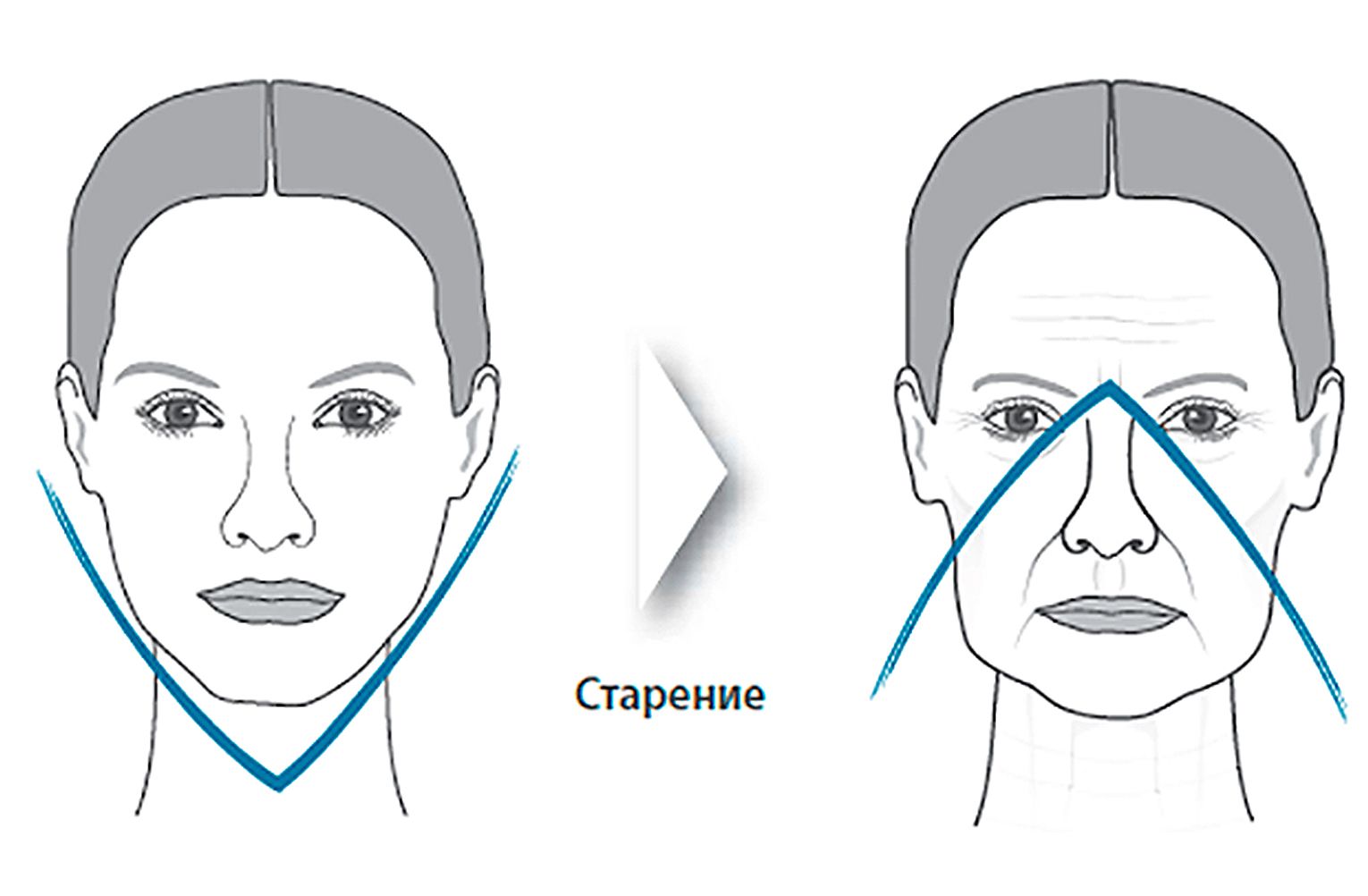Почему обвисают щеки