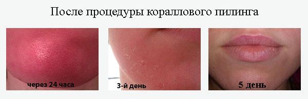 Лицо после процедуры кораллового пилинга