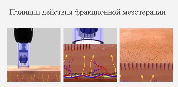 Принцип действия фракционной мезотерапии